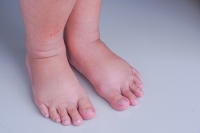 Lymphedema of the Feet